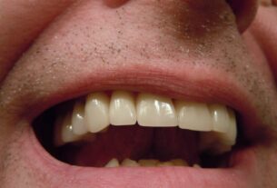 Podniesienia zwarcia z odbudowa zębów