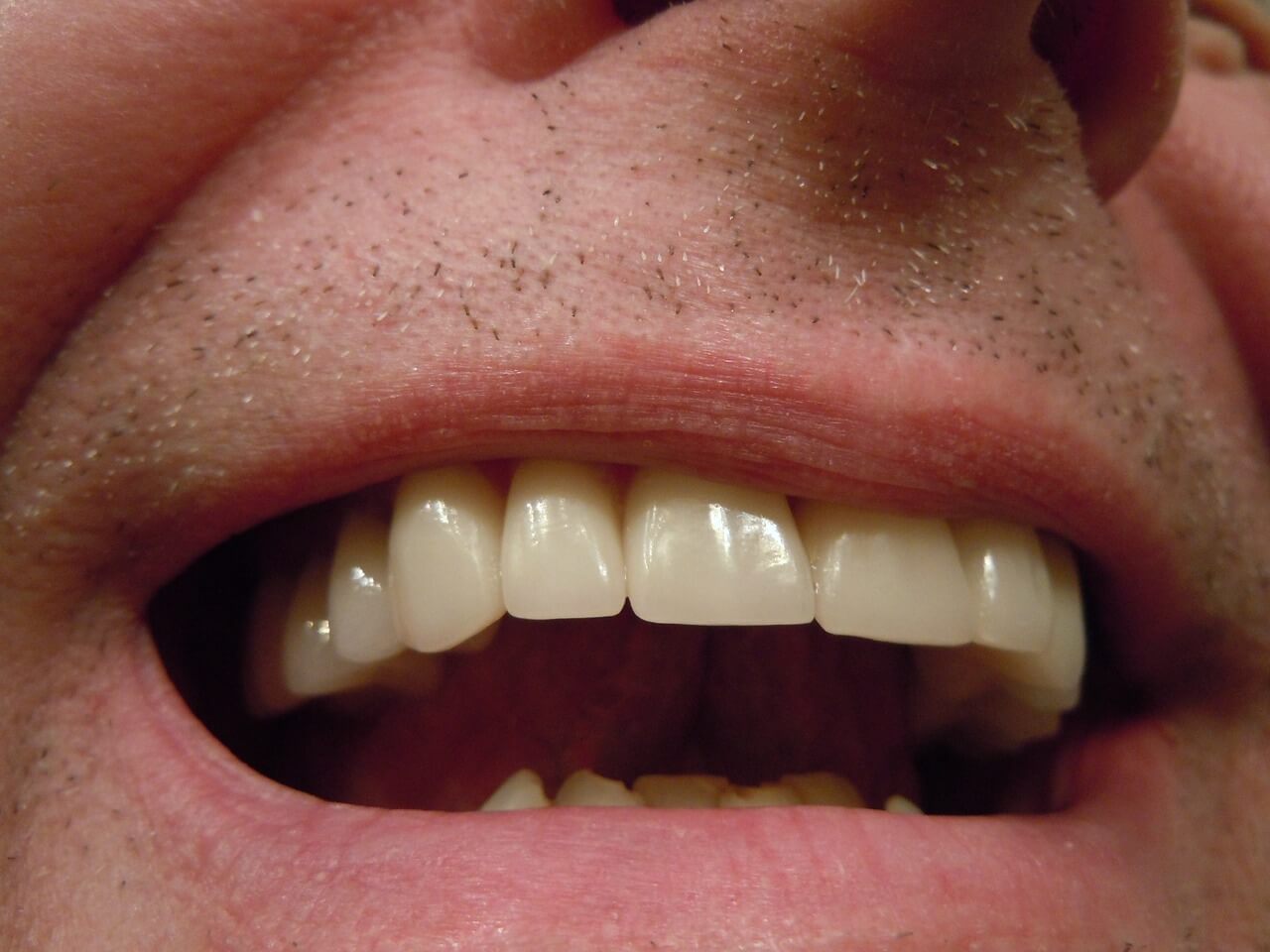 Podniesienia zwarcia z odbudowa zębów